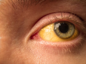 Icterícia: Olho amarelado causado pelo acúmulo de bilirrubina no sangue.