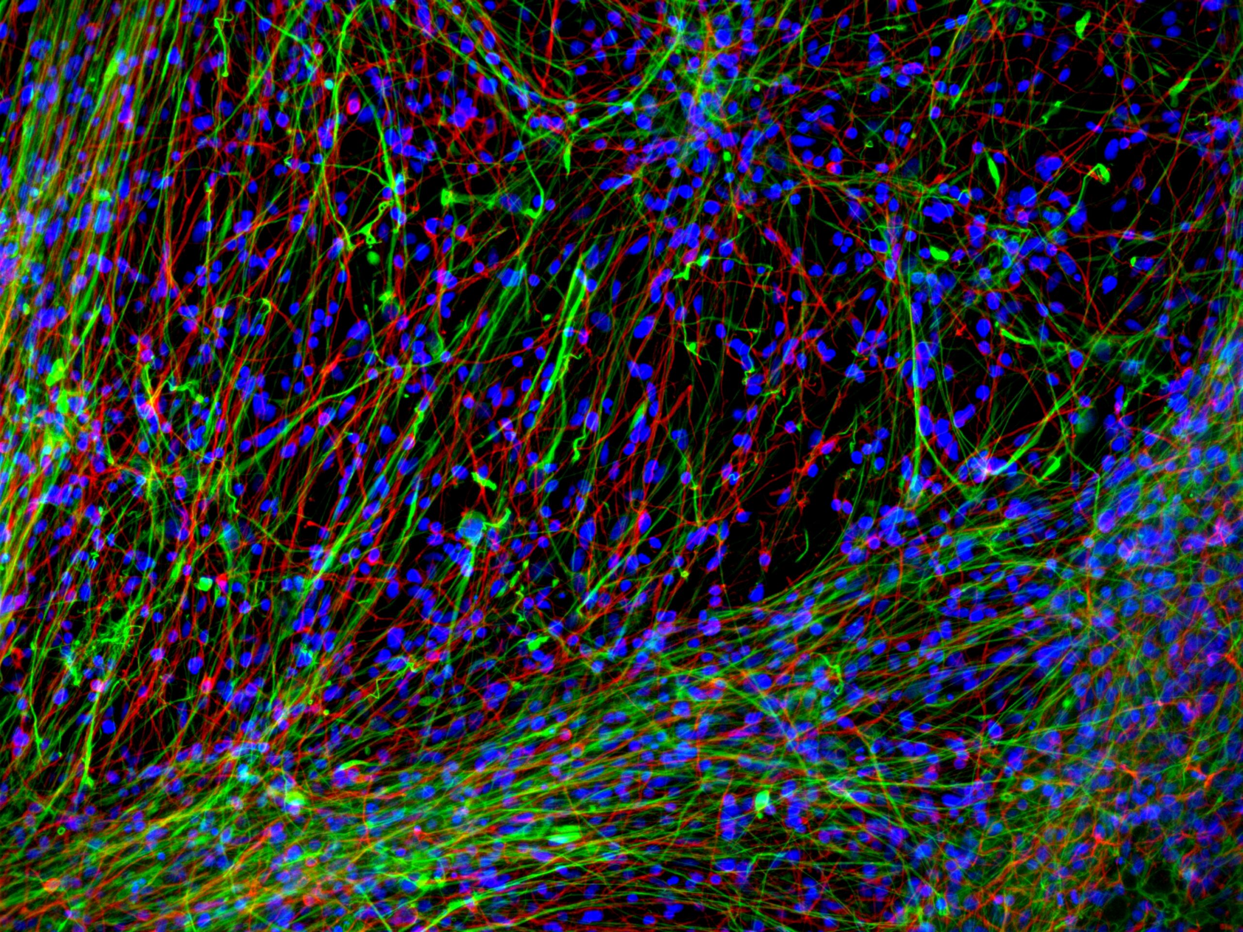 “Big Brother” celular: modelo 3D com células humanas permite observar metástases cerebrais em tempo real e abre caminho para novos tratamentos